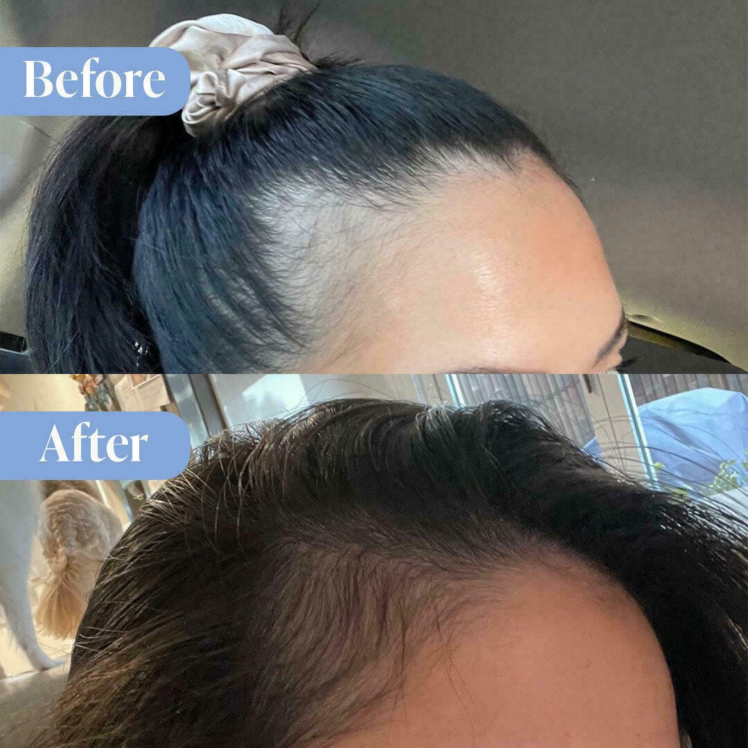 Anti-Hair Loss Bundle + Exfoliating Scalp Scrub - Image 3